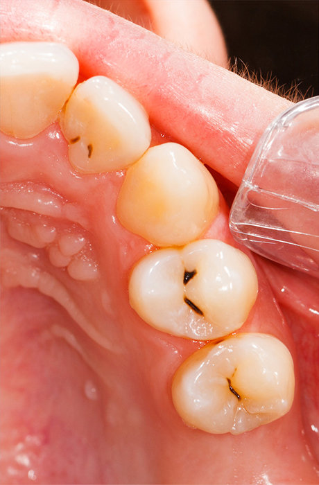 Dental composite filling - Before