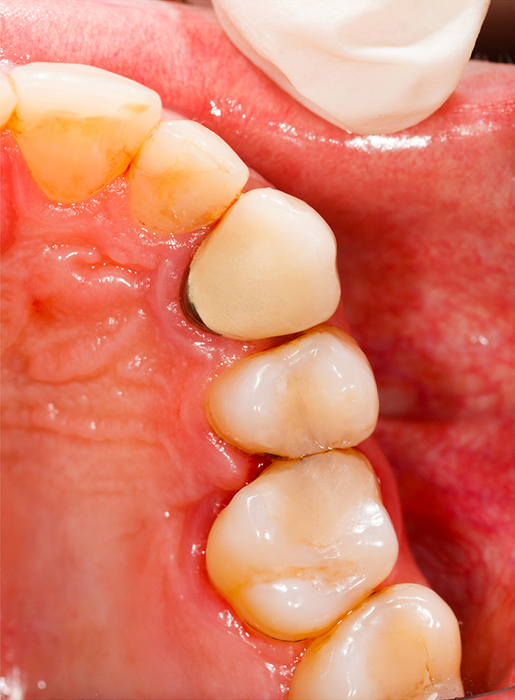Composite White Fillings - After