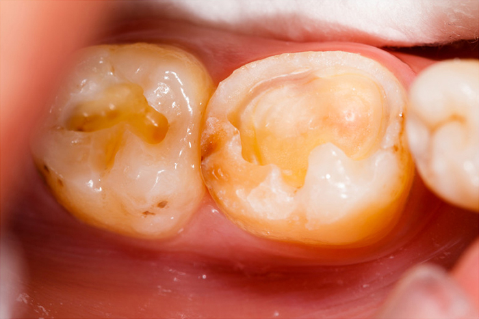 Composite White Fillings - Before