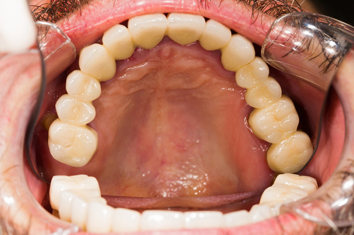 Full mouth reconstruction with porcelain bridges and crowns