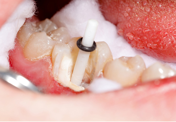 Tooth Restoration - During