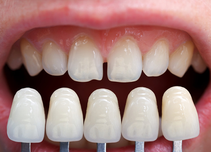 Shade determination with the help of a shade guide for tooth whitening